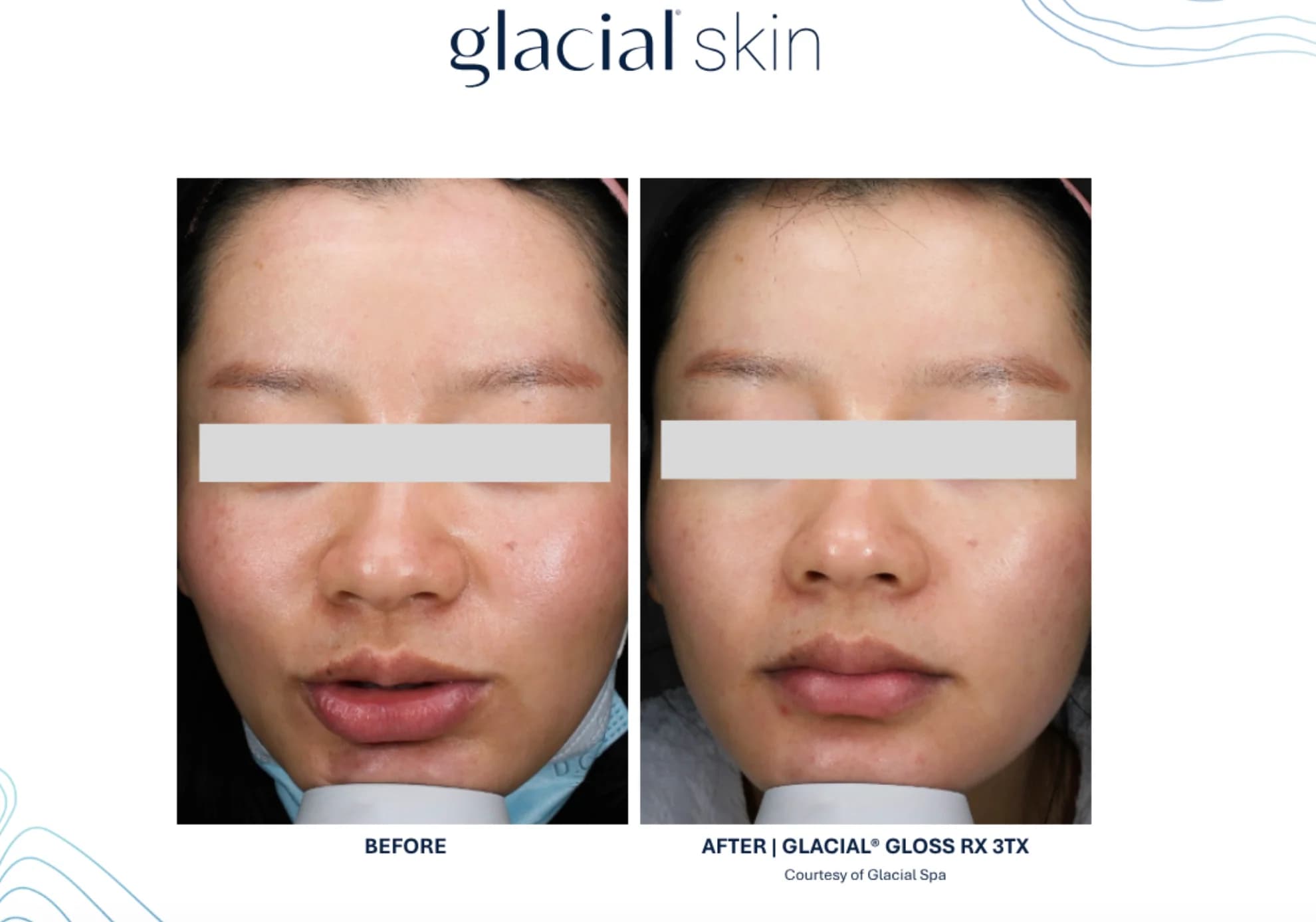 Glacial Skin — 시술 전후 1