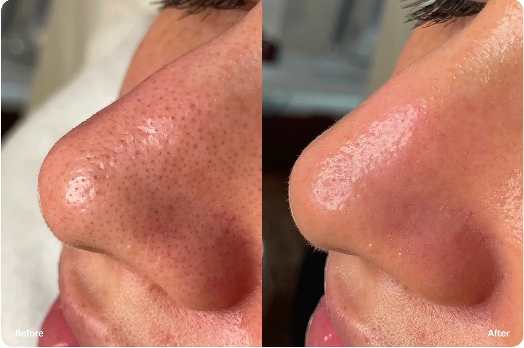 HydraFacial 水飞梭 — 前后对比 1