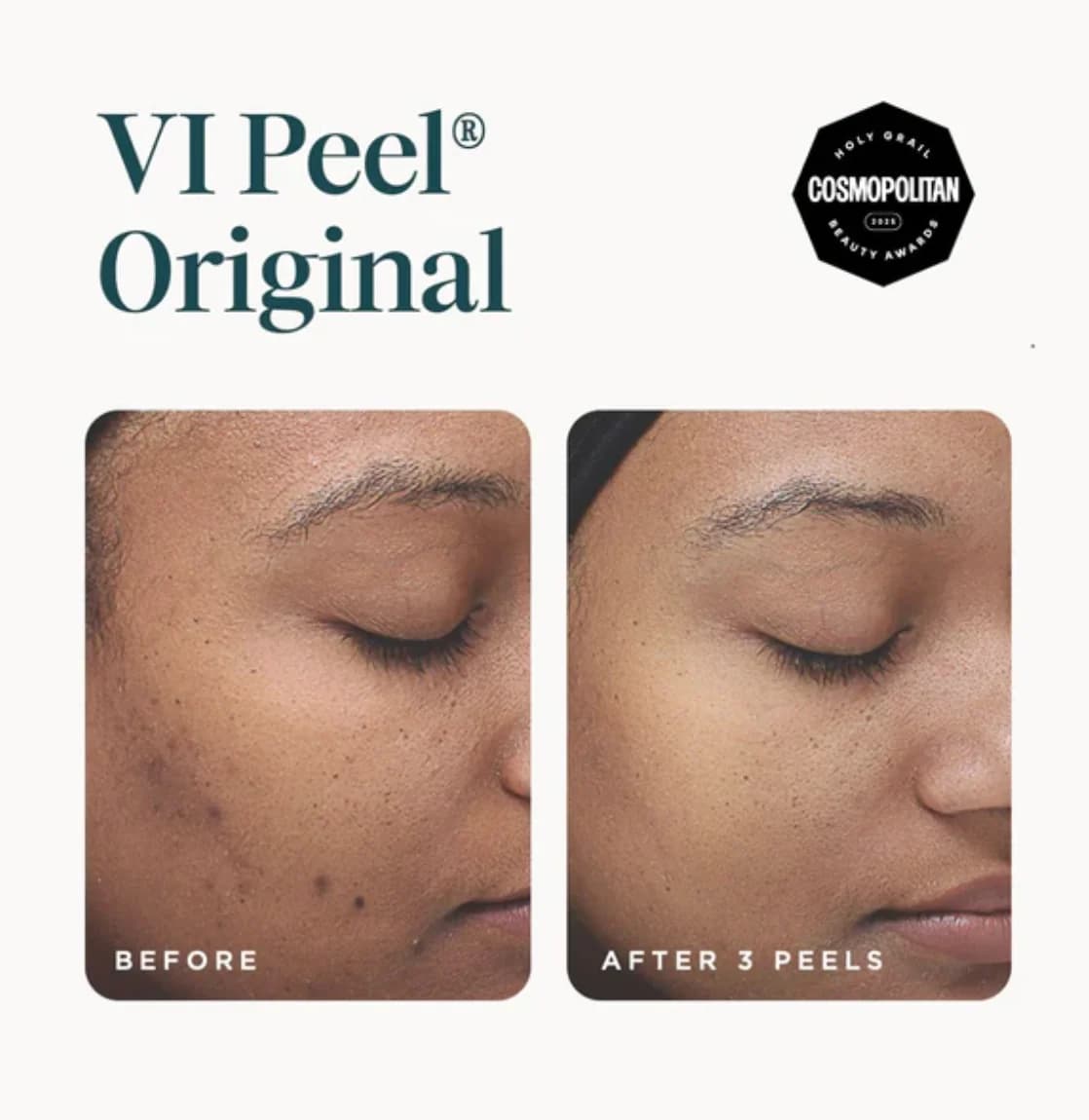 VI Peel® — 시술 전후 1