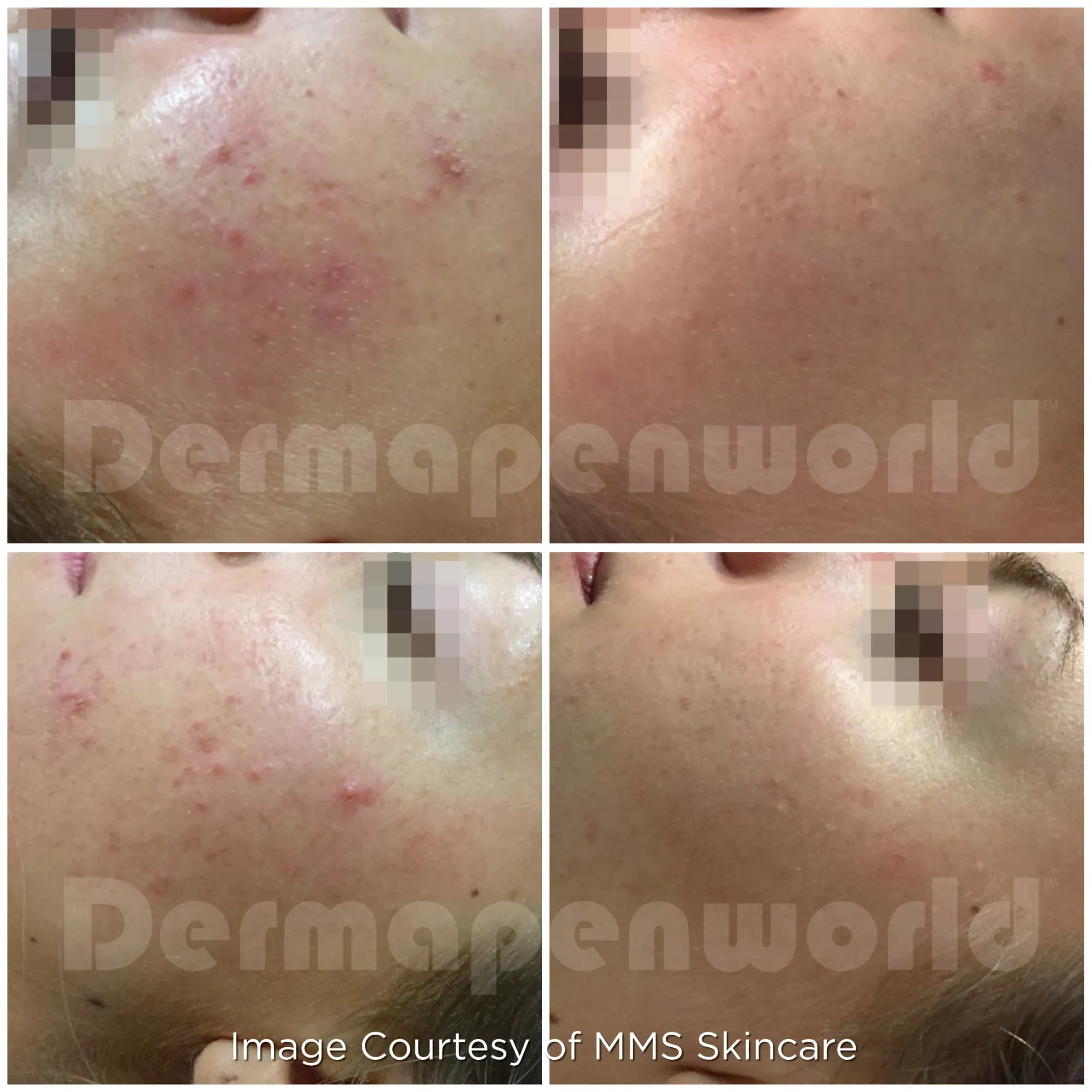 DermapenWorld™ Dermapen 4™ — 시술 전후 1