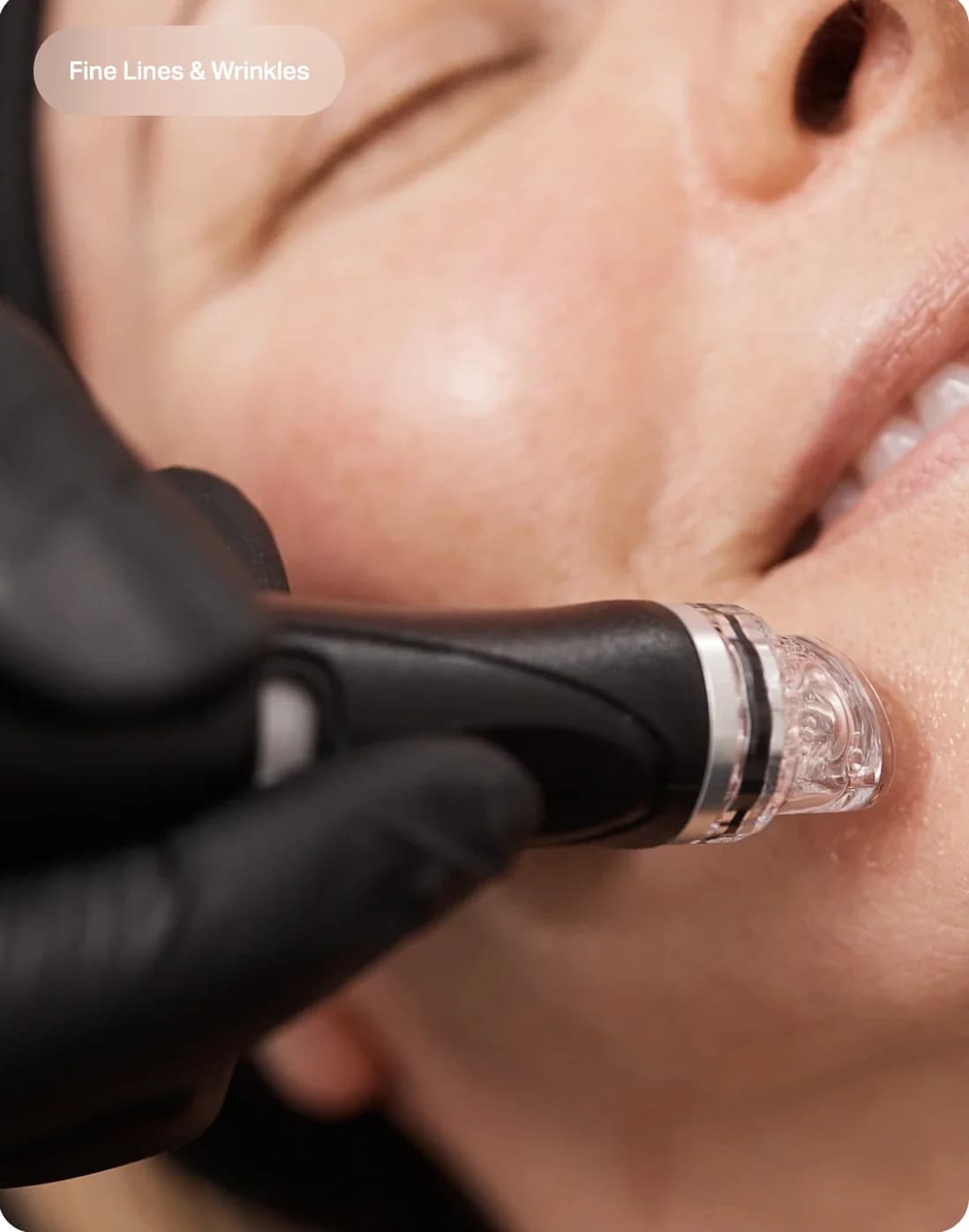 HydraFacial 하이드라페이셜