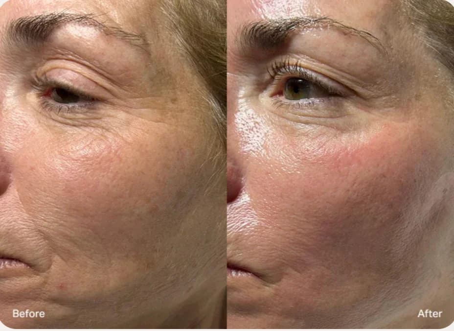 HydraFacial 水飞梭 — 前后对比 2