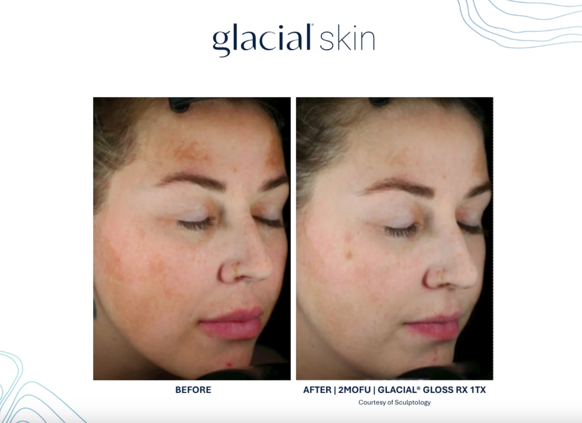 Glacial Skin（Cool Restore®） — 前后对比 2