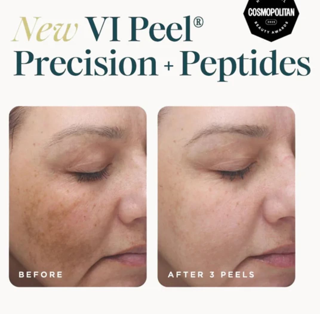 VI Peel® — 시술 전후 2